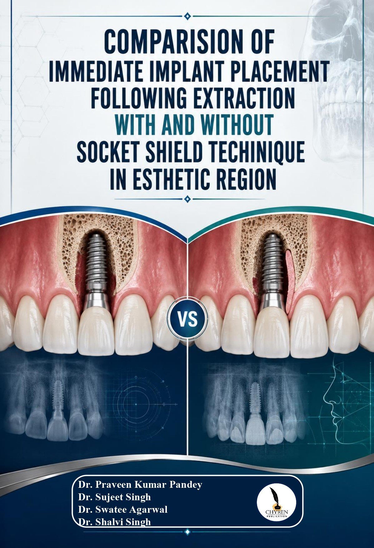 COMPARISION OF IMMEDIATE IMPLANT PLACEMENT FOLLOWING EXTRACTION WITH AND WITHOUT SOCKET SHIELD TECHINIQUE IN ESTHETIC REGION